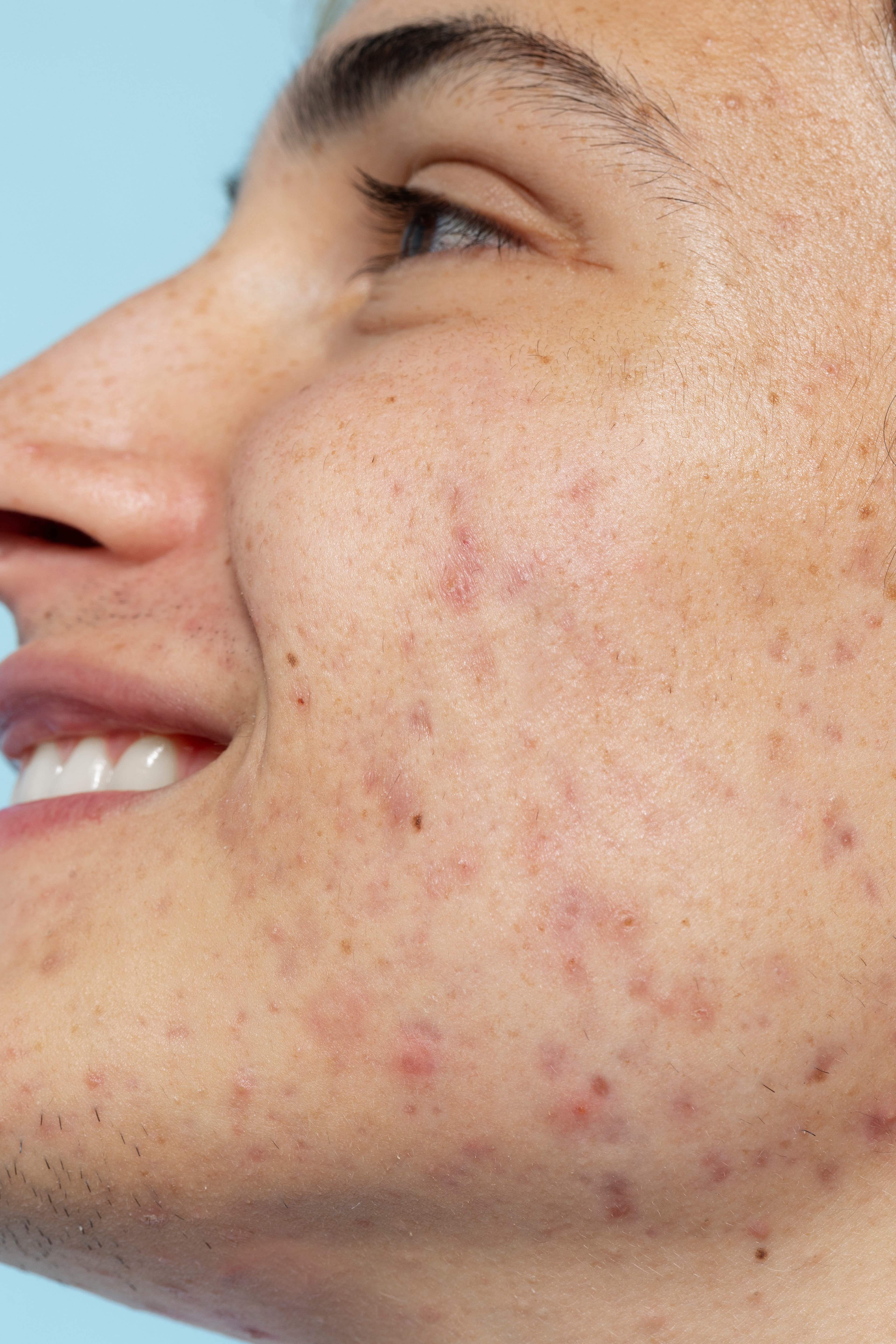 Mild Acne & Pimple